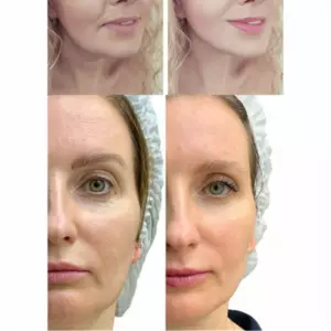 МІКРОСТРУМОВИЙ RF ЛІФТИНГ-МАСАЖЕР ДЛЯ ОБЛИЧЧЯ MEDICA+ SKIN LIFTING 7.0 WHITE ЯПОНІЯ (EMS+LED)